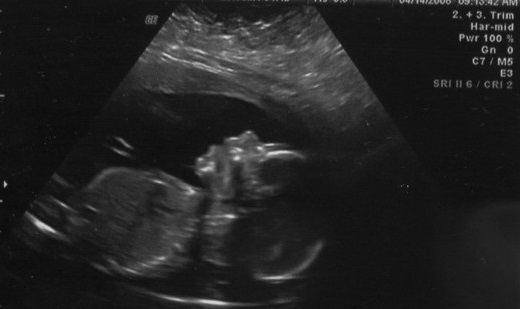 ultrasound
